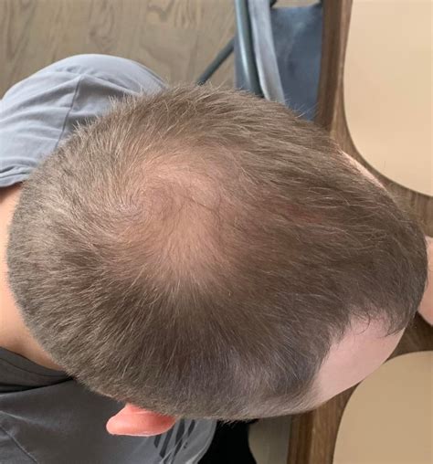 r/tressless|best hair loss forums.